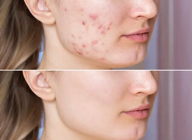 نتیجه قبل و بعد استفاده از سرم ضدجوش